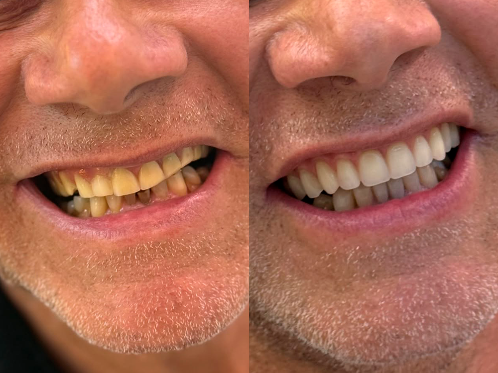 Caso de implantes dentários