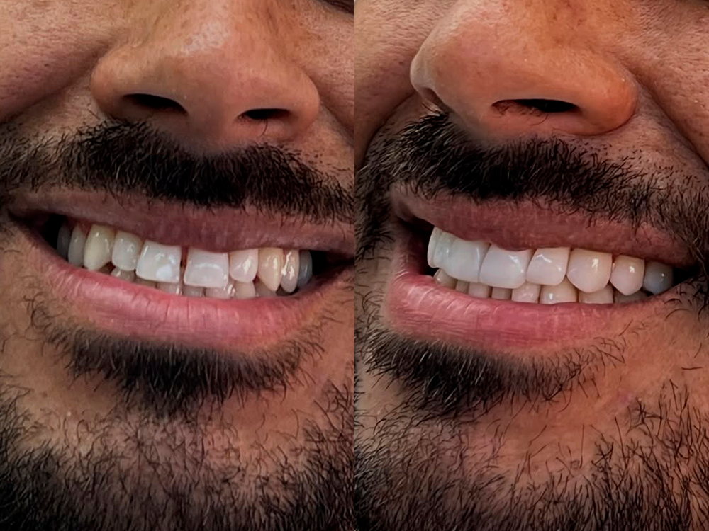Caso de lentes de contato dental
